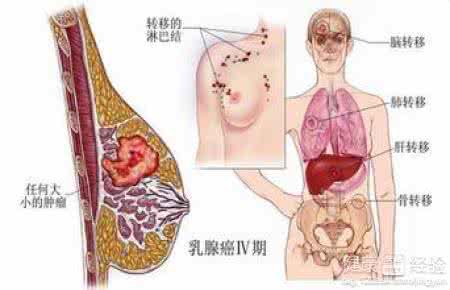 乳腺癌治愈率 乳腺癌治愈率 乳腺癌能治好吗