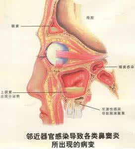 鼻炎和鼻窦炎那个严重 鼻炎、鼻窦炎特效秘方制作方子