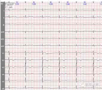 心电图教学视频全集 每天学看一份心电图（第27期）二度II型房室传导阻滞
