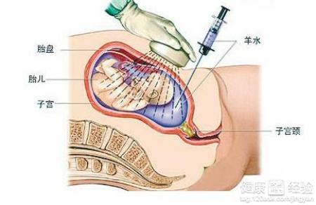 羊水穿刺不做可以吗 羊水穿刺的必要性