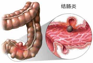 慢性肠炎吃什么药 慢性肠炎吃什么药 如何有效治疗慢性肠炎