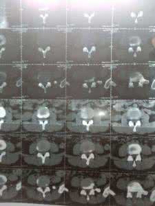 腰间盘突出特效药 腰间盘突出：特效方只需3样！艾叶、米醋、白酒，药到病除！