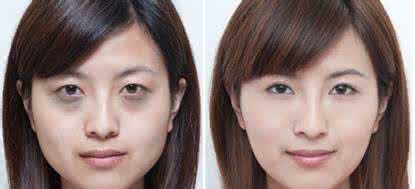 专业祛除黑眼圈 专业祛除黑眼圈 整形可以祛除各种黑眼圈？