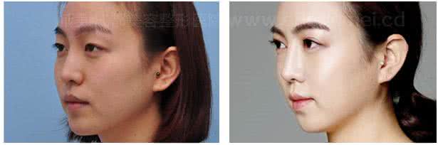 如何改善肌肤暗黄 如何改善四种最常见的肌肤暗黄