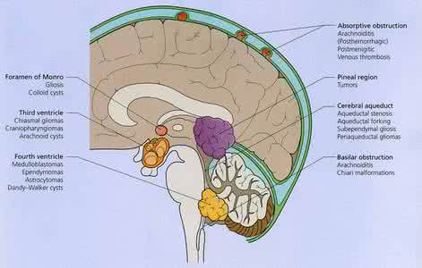 颅内压增高治疗 颅内压增高 如何治疗颅内压增高