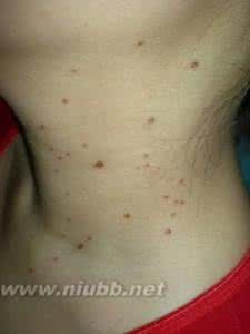 脖子上长疙瘩的原因 脖子长小肉疙瘩是什么原因