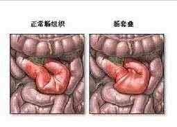 肠套叠和肠绞痛的区别 肠胀气与肠套叠区别 如何区分肠胀气与肠套叠？