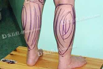 瘦小腿吸脂手术费用 小腿吸脂手术 小腿吸脂手术种类