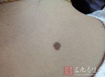 黑痣脱落 痣上的毛脱落后结果太恐怖了