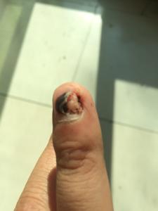 指甲盖被砸紫后怎么办 指甲盖被砸 指甲盖被砸紫后怎么办?