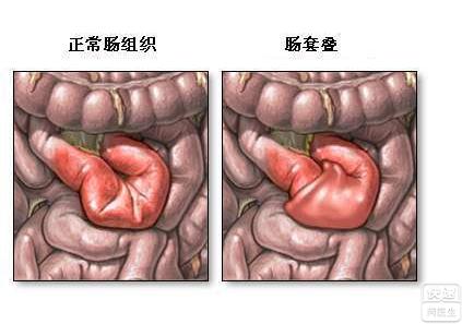 肠梗阻的四大症状是 肠梗阻什么症状 大肠梗阻有什么症状特点