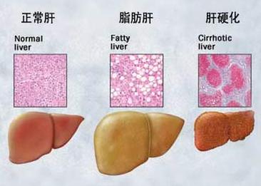 脂肪肝可怕吗 轻度脂肪肝可怕吗 脂肪长这最可怕，每天一口8年香醋，融掉坏脂肪，赶紧看~