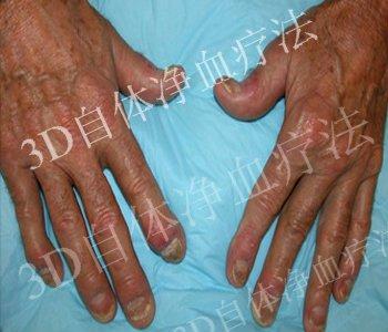 银屑病的病因 银屑病是怎么引起的 银屑病的四大病因