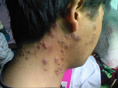 皮肤病有哪几种图片 皮肤病