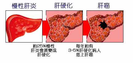 肝硬化晚期是肝癌吗 晚期肝硬化（肝癌）的治疗方法