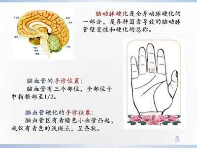 心脑血管硬化 手诊之——心脑血管硬化