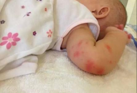 宝宝被蚊子咬到满脸包 宝宝被蚊子叮了起包怎么办