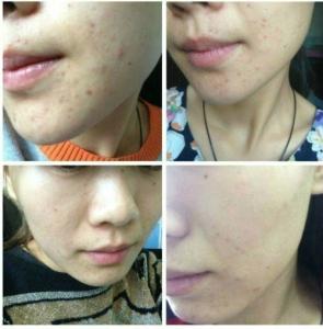 痘痘发炎吃什么消炎药 消痘痘能吃消炎药吗？