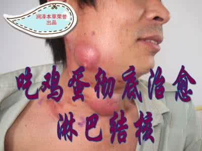 老鼠疮是淋巴癌吗 治淋巴结方(又名老鼠疮)淋巴结癌 淋巴结核