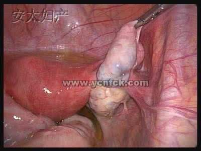 带环第一次来月经量多 上环后月经量多怎么办