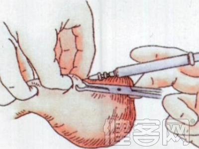 男人结扎还能生育吗 男人结扎还能生育吗?