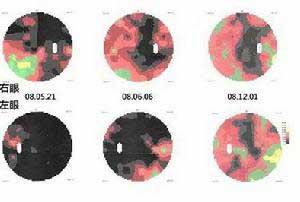 黑色素瘤靶向药物 新型药物或能有效阻断90%的黑色素瘤转移