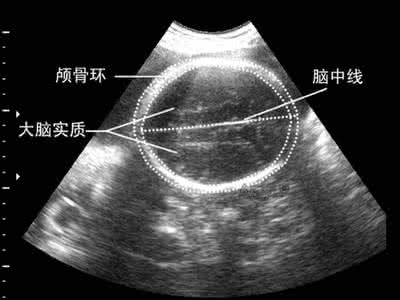 胎儿颅骨光环完整 胎儿颅骨光环完整 胎儿颅骨光环完整表示什么