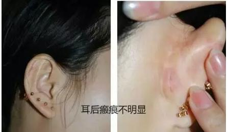 耳软骨垫鼻尖后遗症 耳软骨垫鼻尖后遗症 耳软骨垫鼻尖后遗症介绍