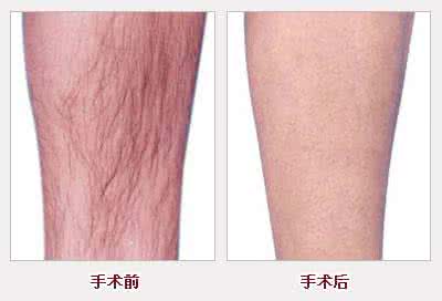 激光脱毛哪里效果好 永久脱毛效果 什么时候做永久激光脱毛效果好