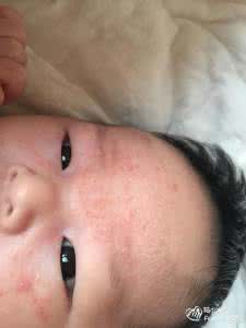 新生儿是唐氏儿的特征 新生儿的皮肤有哪些感觉特征