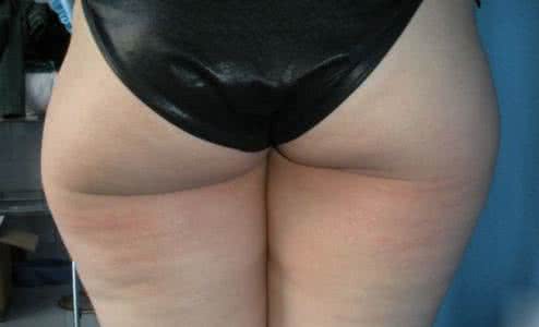 臀部长了个硬包 臀部长了个硬包 梦见臀部或屁股