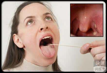 扁桃体结石怎么治疗 扁桃体结石 扁桃体结石怎么治疗