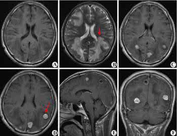 脑胶质瘤的病因是什么 脑转移瘤 脑转移瘤的病因是什么