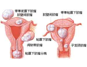 卵巢囊肿是什么原因 女性卵巢囊肿原因是什么