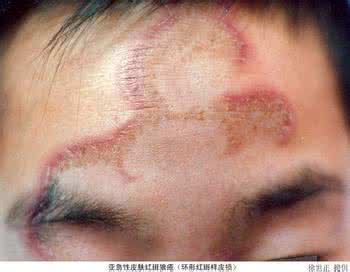 系统性红斑狼疮寿命 系统性红斑狼疮寿命 系统性红斑狼疮症状