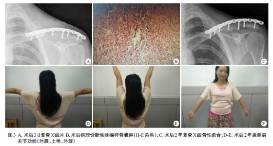 动脉瘤样骨囊肿 动脉瘤样骨囊肿 带你认识动脉瘤样骨囊肿