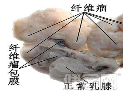 乳腺纤维瘤如何治疗 乳腺纤维瘤 乳腺纤维瘤如何治疗