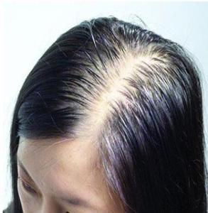 脂溢性脱发症状及治疗 什么是脂溢性脱发