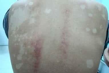 汗斑的最佳治疗方法 汗斑1方