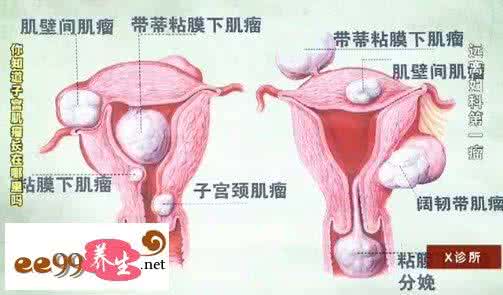 治疗子宫肌瘤症状 子宫肌瘤症状 正确治疗子宫肌瘤