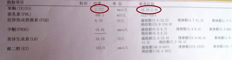 多囊卵巢综合症瘦了就 多囊性卵巢综合症 多囊卵巢综合症诊断