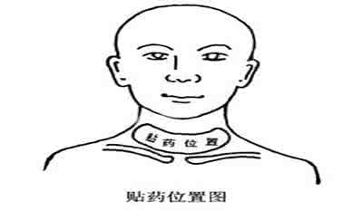 甲亢吃什么药效果好 甲亢不能吃什么 甲亢饮食禁忌