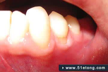 牙龈萎缩吃什么药 预防牙龈萎缩注意什么?