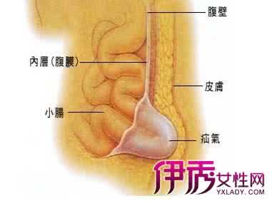 疝气病的症状 疝气是什么病 疝气的症状与治疗