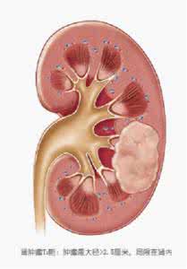 早期肾癌术后8年复发 早期肾癌术后8年复发 肾癌易复发吗几年内