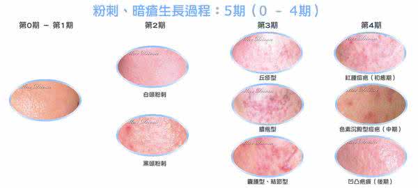 暗疮的最佳治疗方法 暗疮的最佳治疗方法 暗疮如何饮食