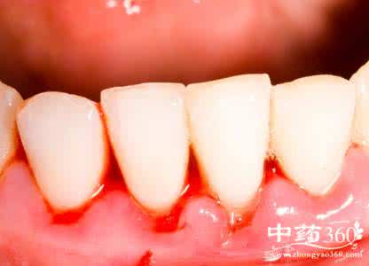 牙龈出血的治疗方法 牙龈出血怎么办才好