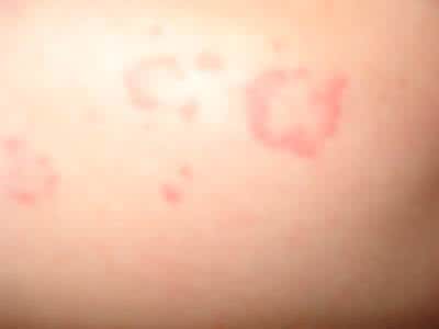 怎么才能患上玫瑰糠疹 患玫瑰糠疹能怀孕吗 如何护理