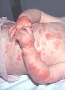 皮肤过敏治疗方法 皮肤过敏治疗有什么方法