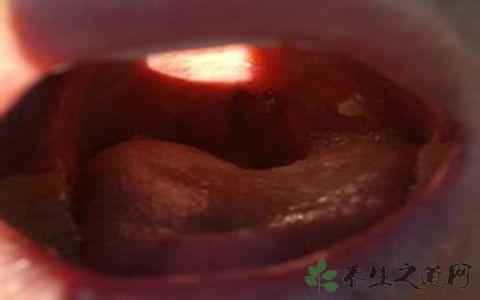 苦杏仁简便吃法 慢性咽炎 不用喝“苦汤药”的简便慢性咽炎方